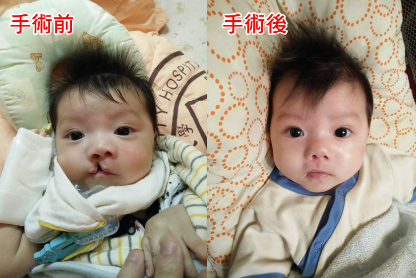 Re: [寶寶] 關於唇顎裂寶寶的手術建議