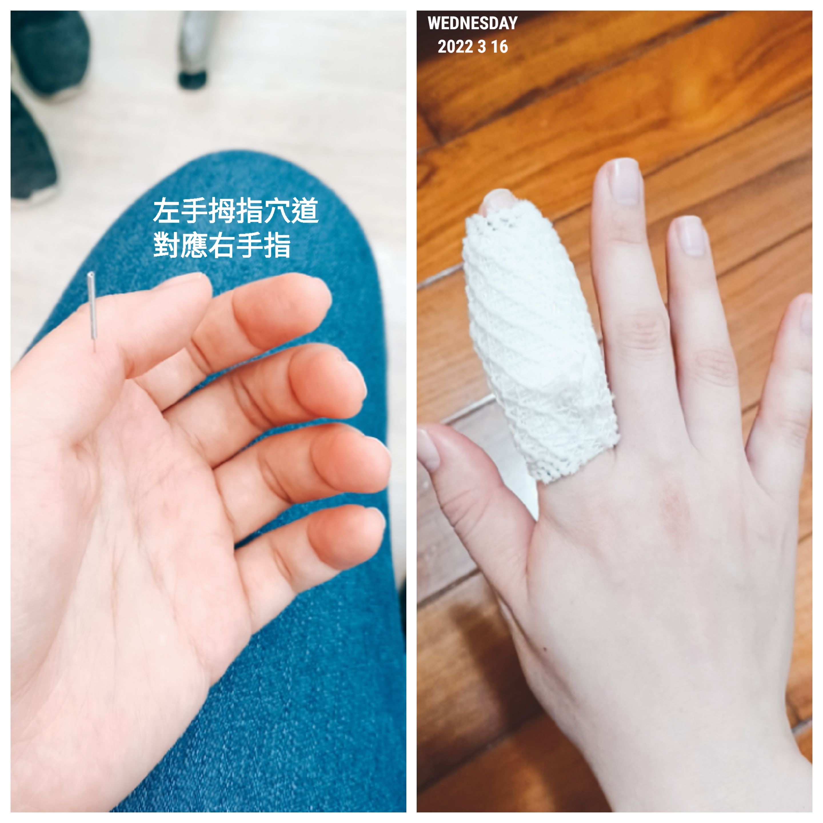 左手右手食指跟中指长了两个疙瘩不疼不痒，请问这是什么问题