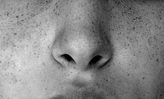 freckles